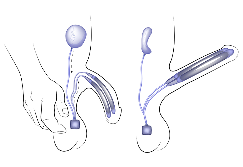 How inflatable penile implants work