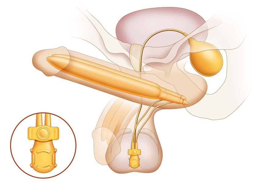 After a penile implant inflatable procedure