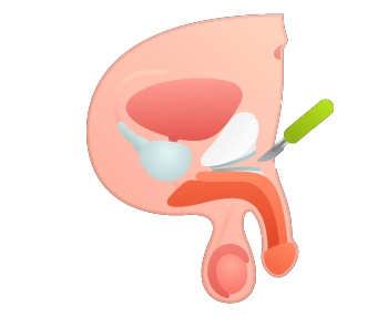 Penile Enlargement STEP 2