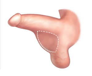 Penile Enlargement - Scrotal Hump Removal Before