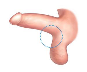 Penile Enlargement - After Scrotal Hernia Removal