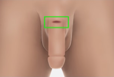 Penile Augmentation - Replacement Dermis STEP 1