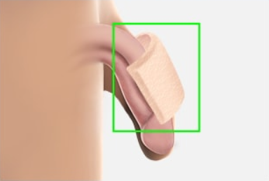Penile Augmentation - Replacement Dermis STEP 2