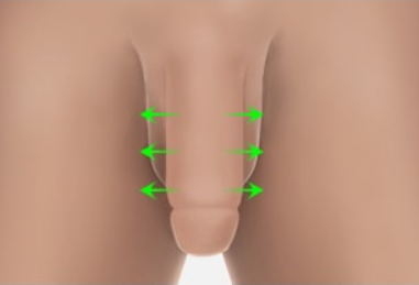 Penile Augmentation - Replacement Dermis STEP 3