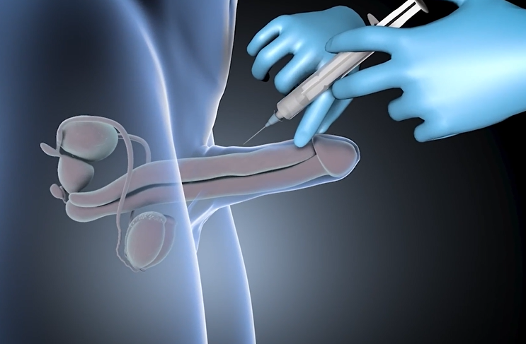 Filler Penile Augmentation STEP 1