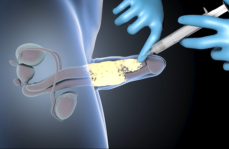 Filler Penile Augmentation STEP 2
