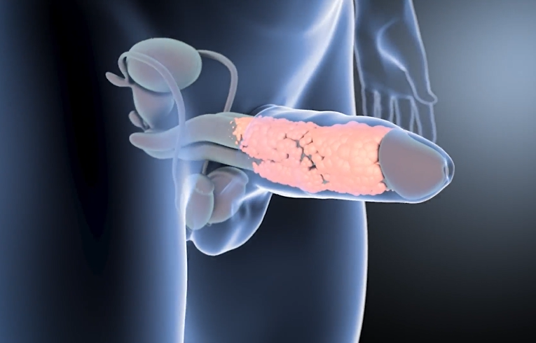 Filler Penile Augmentation STEP 3