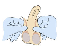 Vasectomy - Procedure STEP 1
