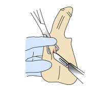 Vasectomy - Procedure STEP 3