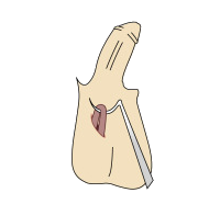 Vasectomy - Procedure STEP 4