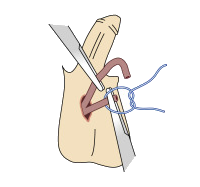 Vasectomy - Procedure STEP 5
