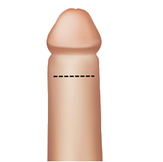 Premature Ejaculation Surgery Procedure STEP 1