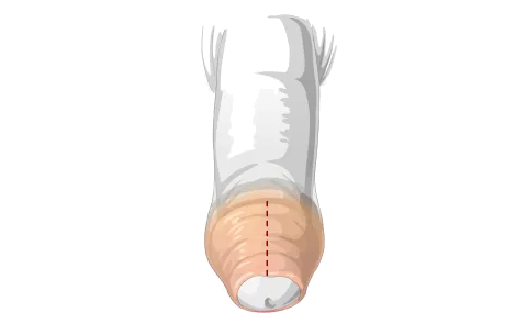 Circumcision - Episiotomy