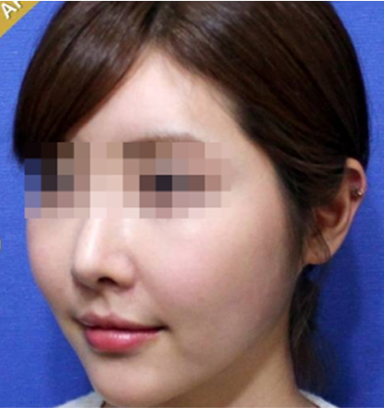 실리프팅 시술 후