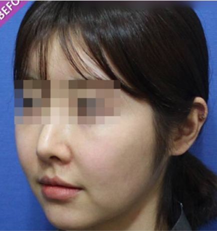 실리프팅 시술 전